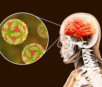 encephalities treatment