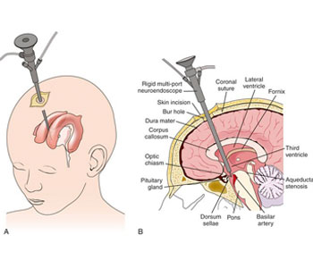 neuro endoscopy treatment