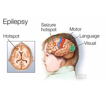 epilepsy treatment