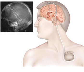 functional neurosurgeon