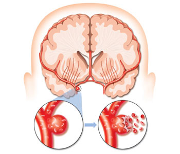 Hemorrhagic
