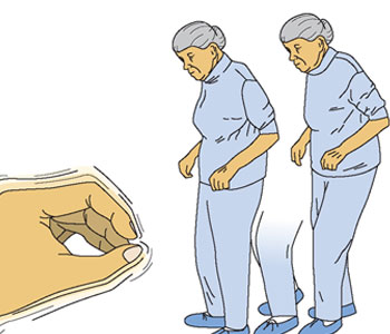 movement disorder treatment
