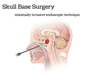 skull base surgeons