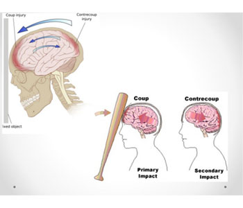 neuro trauma treatment