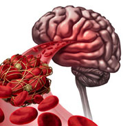 brain stroke treatment